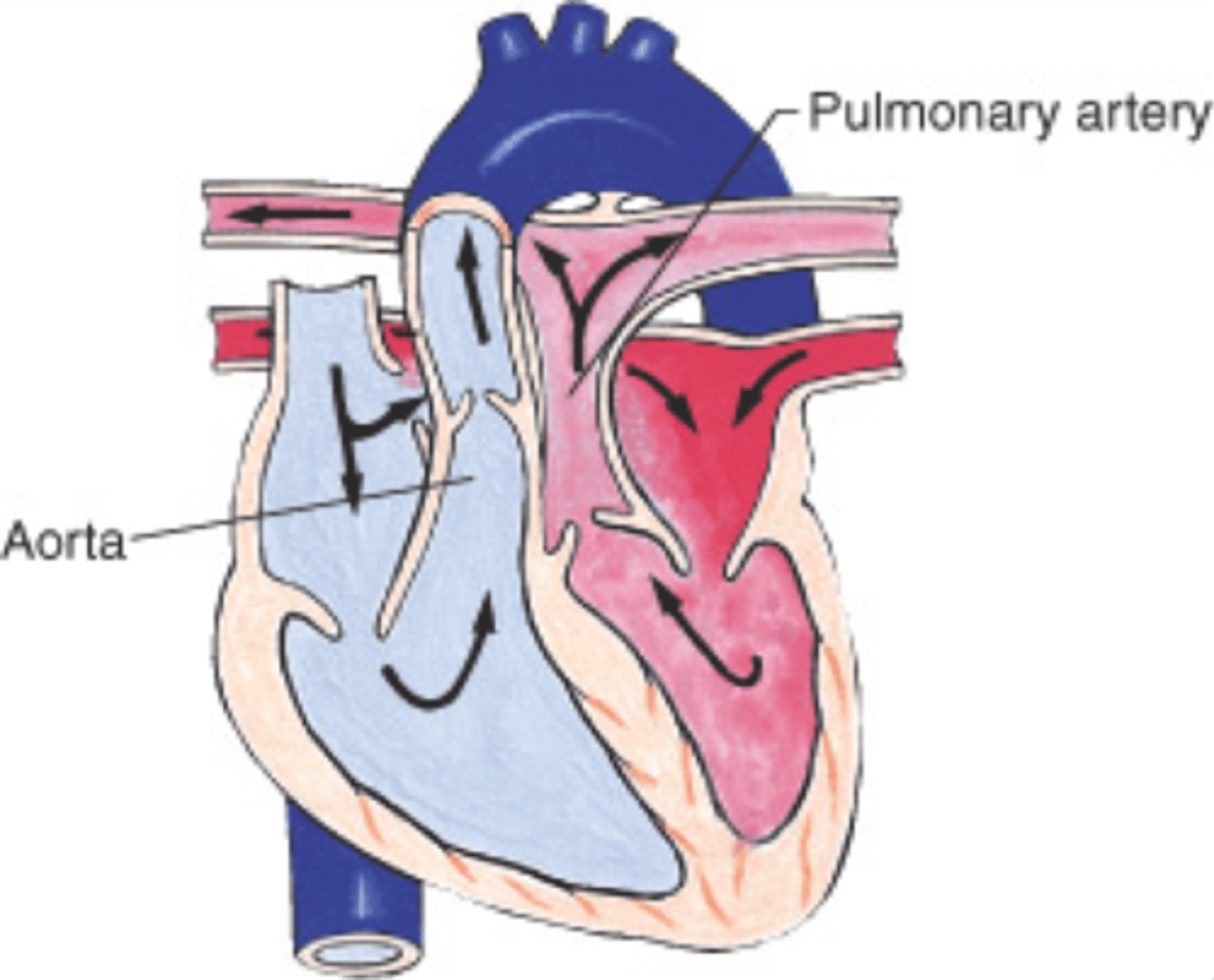 <p>Cyanotic congenital heart defect where the aorta communicates w/ the RV, while the pulmonary trunk communicates w/ the LV; it is incompatible with life!!</p>