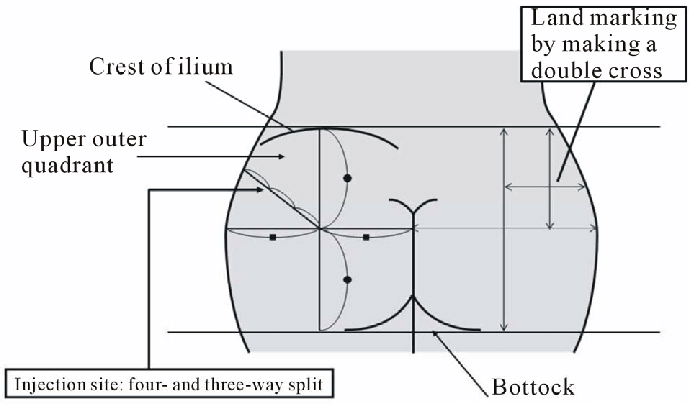 The first thing to understand about the dorsogluteal im site is where it is located. For a visual, you should divide the buttocks into four quadrants. To locate the site of injection you will simply find the upper and outer section of that grid. It is located high on the buttocks, near the thigh.