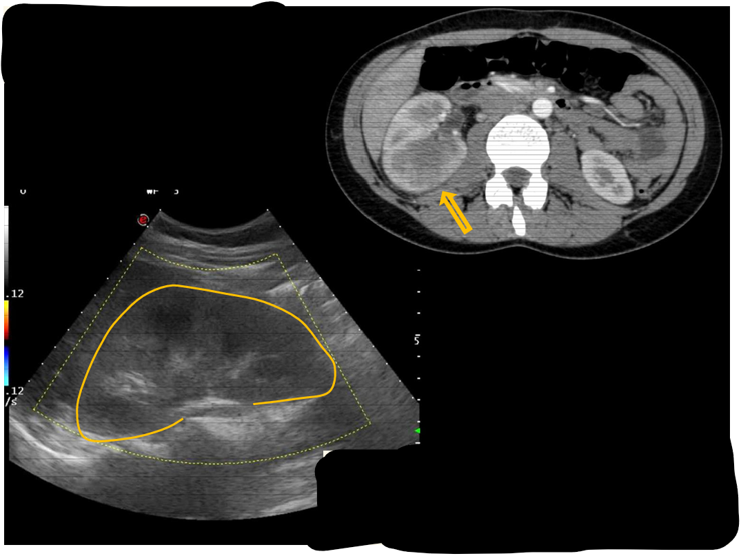 <p>Modality: contrast-enhanced CT; arterial phase </p><p>Region: abdomen, axial view </p><p>Radiologic sign: inhomogenic, enlarged right kidney with patchy hypoenhancement </p><p>Diagnosis: acute pyelonephritis (right kidney)</p>