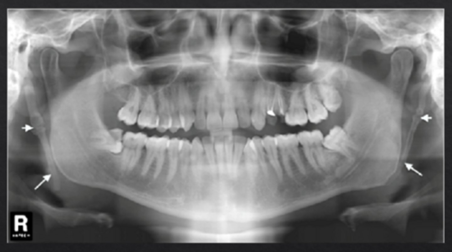 <p>Linear radiopacity extending from skull base toward hyoid</p>
