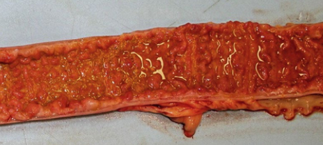 <p>this is a chronic disease:</p><p>-weight loss and peripheral edema (hypoproteinemia)</p><p>-fever, lethargy, diarrhea, colic</p><p>-rarely, fatal necrotizing enteritis w/ severe systemic dz</p>