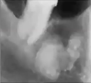 <p>Where might you find idiopathic osteosclerosis?</p>