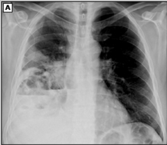 <p>44 y/o patient presents to the ER with cough. While collecting a history the patient reports a recent weight loss (15 lbs) without trying and malaise. She reports that the cough is wet and when she coughs up the sputum it smells terrible. Vitals are stable with the exception of a temp of 101.4. CXR shows multiple areas of cavitation within an area of consolidation. What are you thinking?</p>