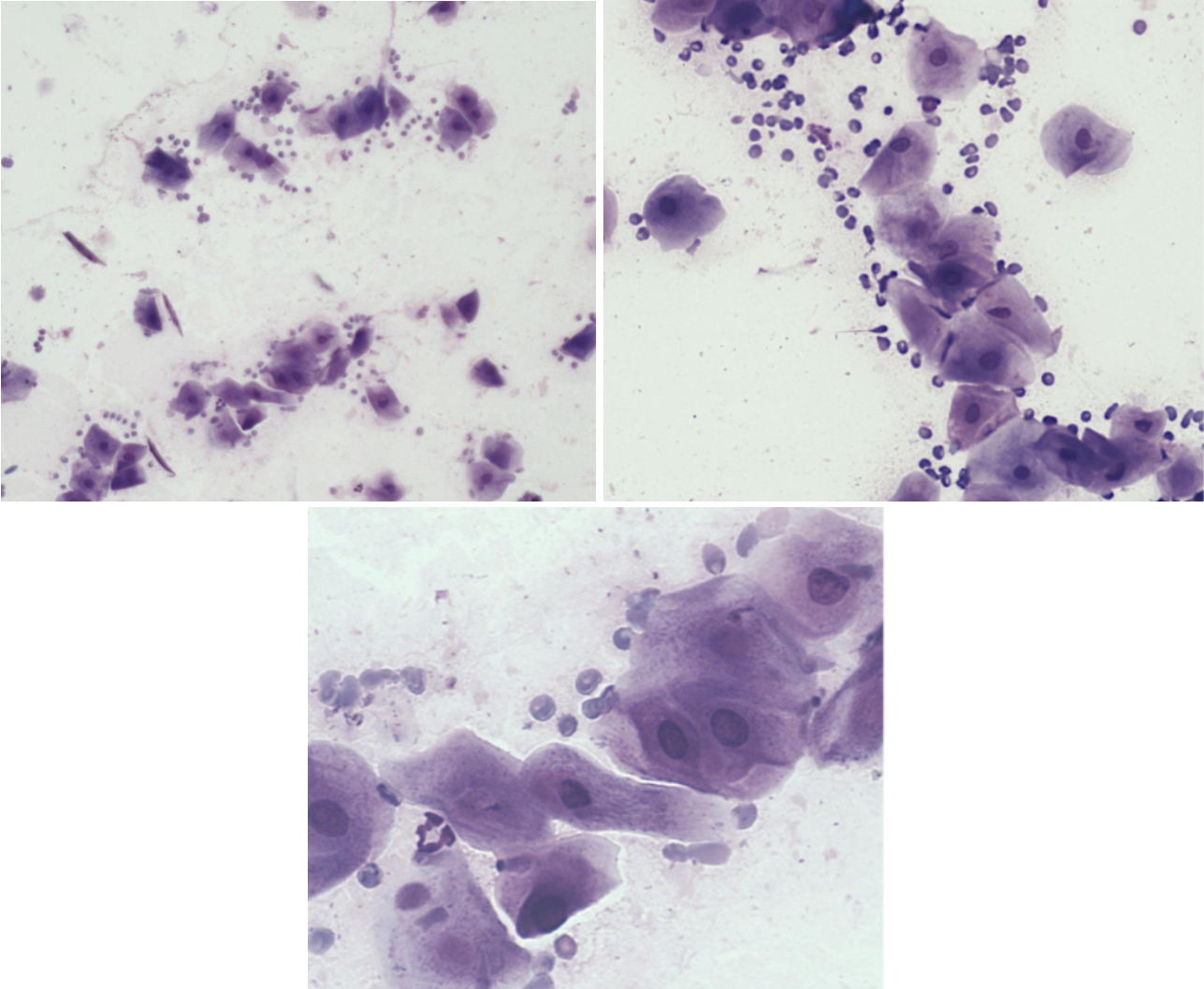 <p>Utrstryk 2<br>Parabasalceller: <br>Intermediärceller: <br>Superficialceller: <br>Erytrocyter: <br>Neutrofiler:</p><p>Stadium:</p>