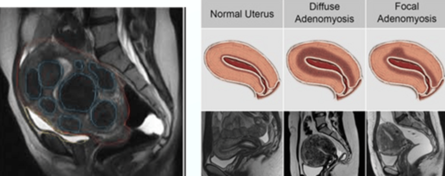 <p>Adenomyosis, Deep endometriosis, Fibroid mapping, and Pelvic malignancy staging</p>