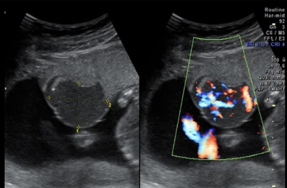 <p>which is assoc w/polyhydramnios</p><p>a) premature rupture of membranes</p><p>b) chorioangioma</p><p>c) renal hypoplasia</p><p>d) renal agenesis </p>