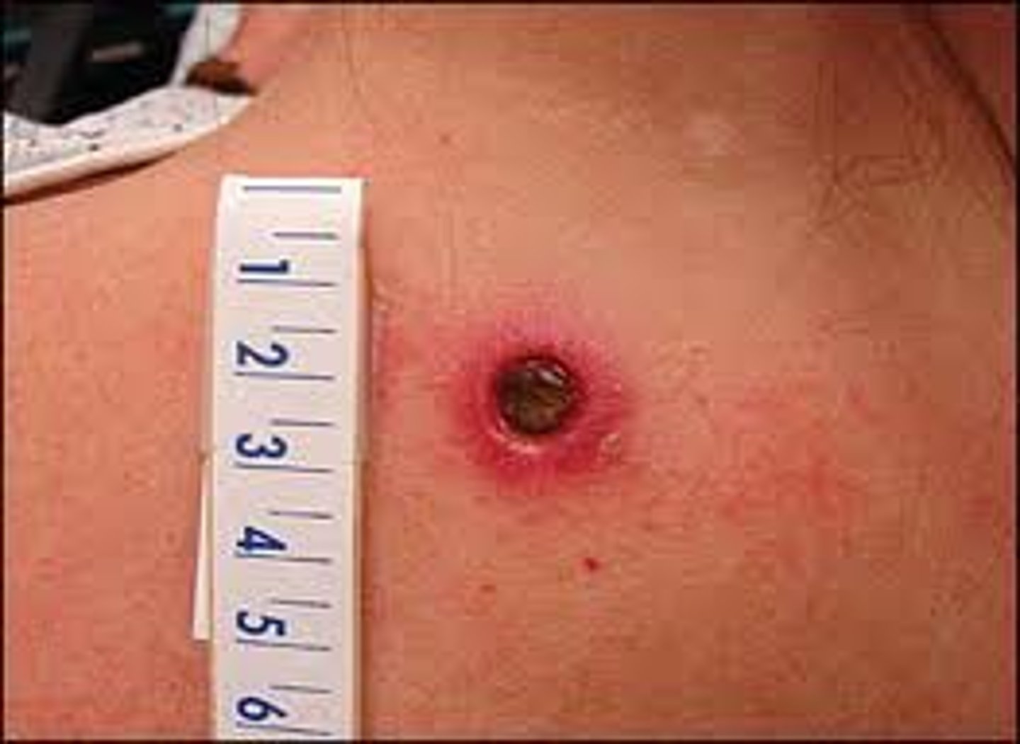 <p>Supportive wound care</p><p>(Cleanse wound and apply ice)</p><p>(The patient most likely has brown recluse spider bite, which are found in warm, dry areas [eg, attics, woodpikes, cellars])</p><p>(vs. Black widow spider: muscle pain/cramps, abdominal rigidity)</p>