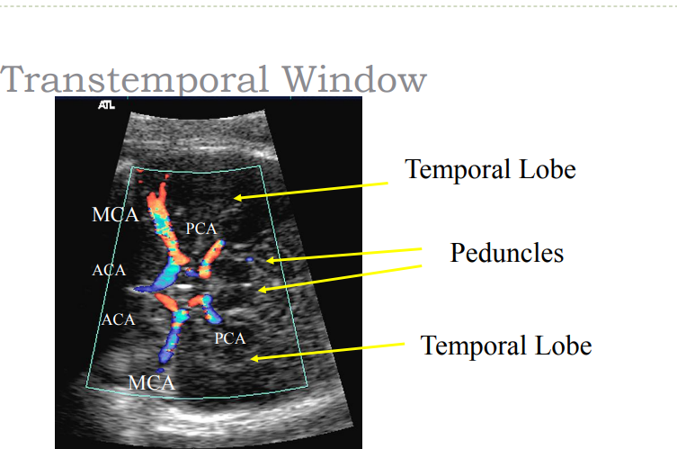 <p>Depth – 60 – 70 mm  </p><p>Flow direction – antegrade / toward  </p><p>Mean velocity – 39 + 10  </p><p>Angle – posterior and inferior </p><p> Cerebral peduncles anatomic landmark </p><p> Identical in size and shape  </p><p>Intermediate echogenicity</p>