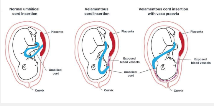 <p><strong>Vasa Previa: Definitions</strong></p><p>-Wharton’s Jelly → a gelatinous connective tissue in the _________ cord present between the amniotic epithelium and the umbilical ________</p><p>-Velamentous umbilical cord insertion → when the placental end of the cord consists of divergent umbilical vessels surrounded only by fetal ___________, with no ___________ jelly&nbsp;</p><p>-Vasa previa → when fetal blood vessels are present in the membranes covering the internal cervical __<strong>, </strong>_________ by placental tissue or Wharton’s jelly&nbsp;</p>