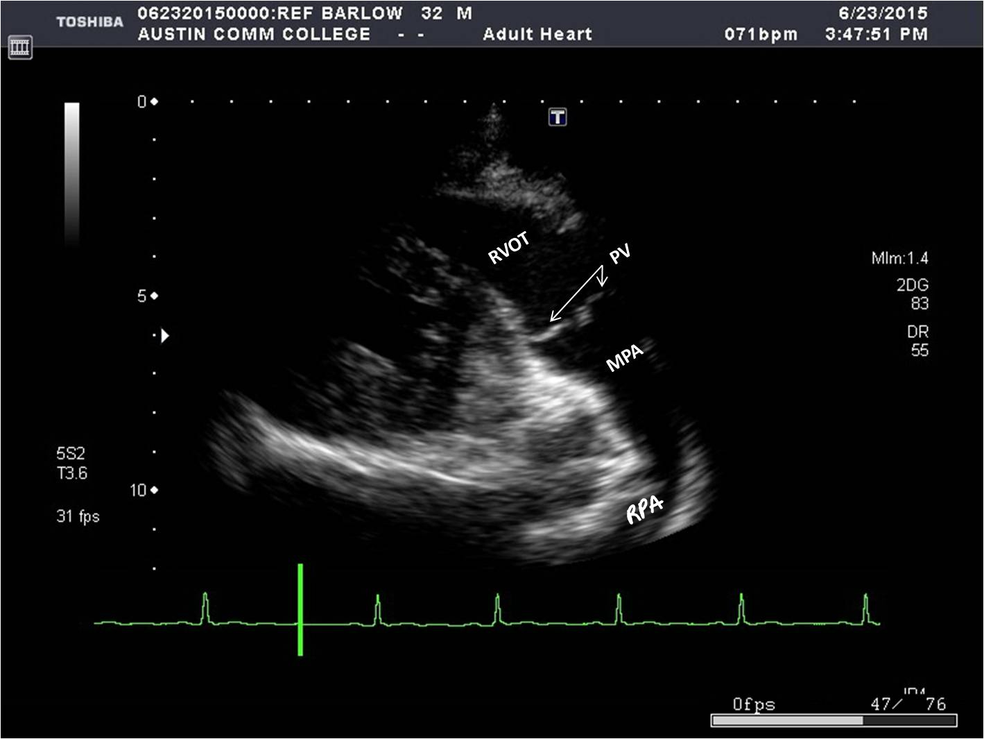 * RVOT
* PV
* Main pulmonary artery (MPA)
* Right pulmonary artery (RPA)