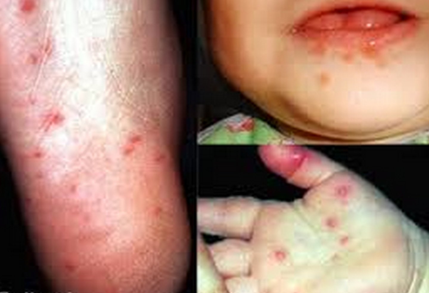 <p>1. Enteroviruses</p><p>2. Spread via mucous or saliva (usually children)</p><p>3. Fever and sore throat; rash and blisters on the hands, feet, mouth, and tongue</p><p>4. Could lead severe symptoms and death (not common)</p>