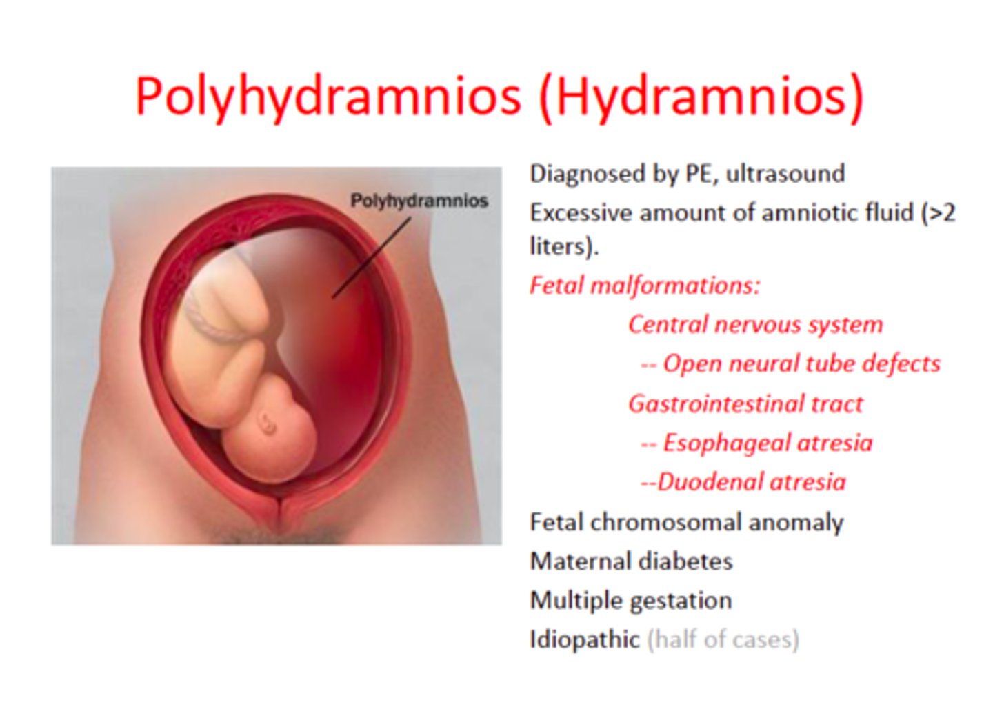 <p>Inability to swallow due to digestive anomalies, maternal diabetes, and twin-to-twin transfusion syndrome (TTTS).</p>