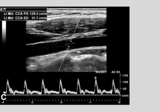 <p>Tachycardia: rapid heartbeat</p>