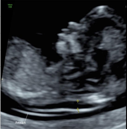 <p>how to obtain the <strong>nuchal translucency</strong> measurement</p><p>.</p><p>a) 2 echogenic lines should be seen posterior to the neck</p><p>b) the full fetus should be seen on the screen</p><p>c) the measurement must be taken at the widest space + from inner to inner dimension recorded</p><p>d) the fetal neck should be hyperextended</p>