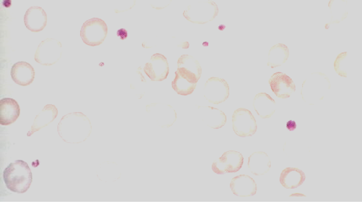 <p>hypochromic</p><p>cells barely are seen after being stained and viewed in peripheral smear</p>
