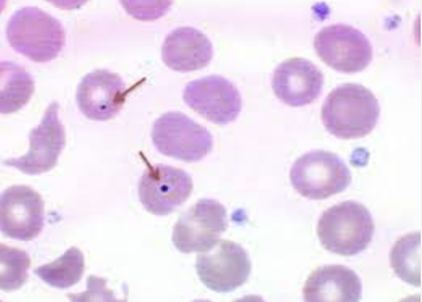 <p>What type of smear cell and what conditions is it seen in</p>