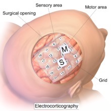 <p>Intracranial EEG (ECOG)</p>