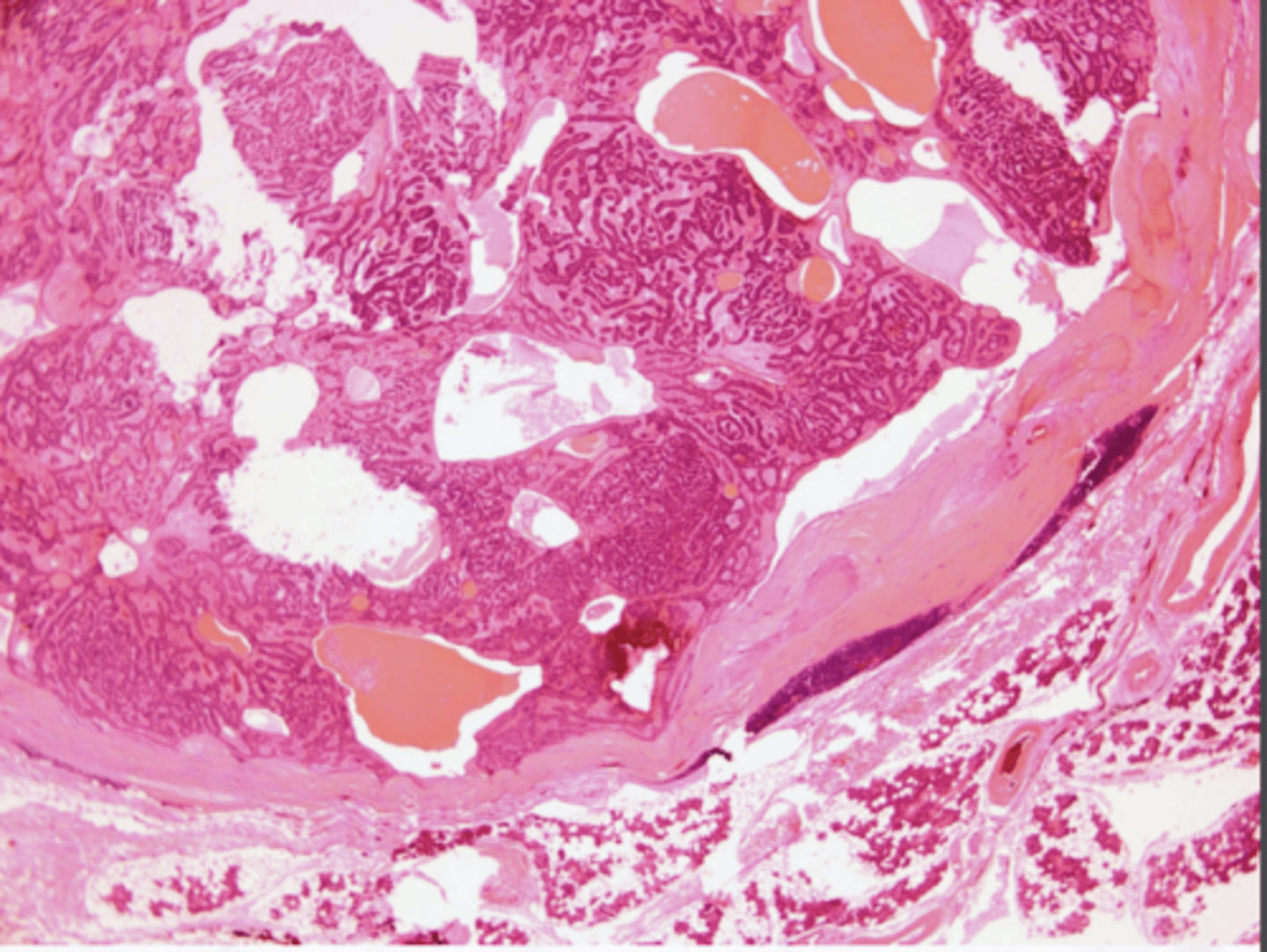 <p>These histologic characteristics are indicative of what oral pathology?</p><p>Well encapsulated</p><p>Cells are similar in appearance</p><p>Look like canals</p>
