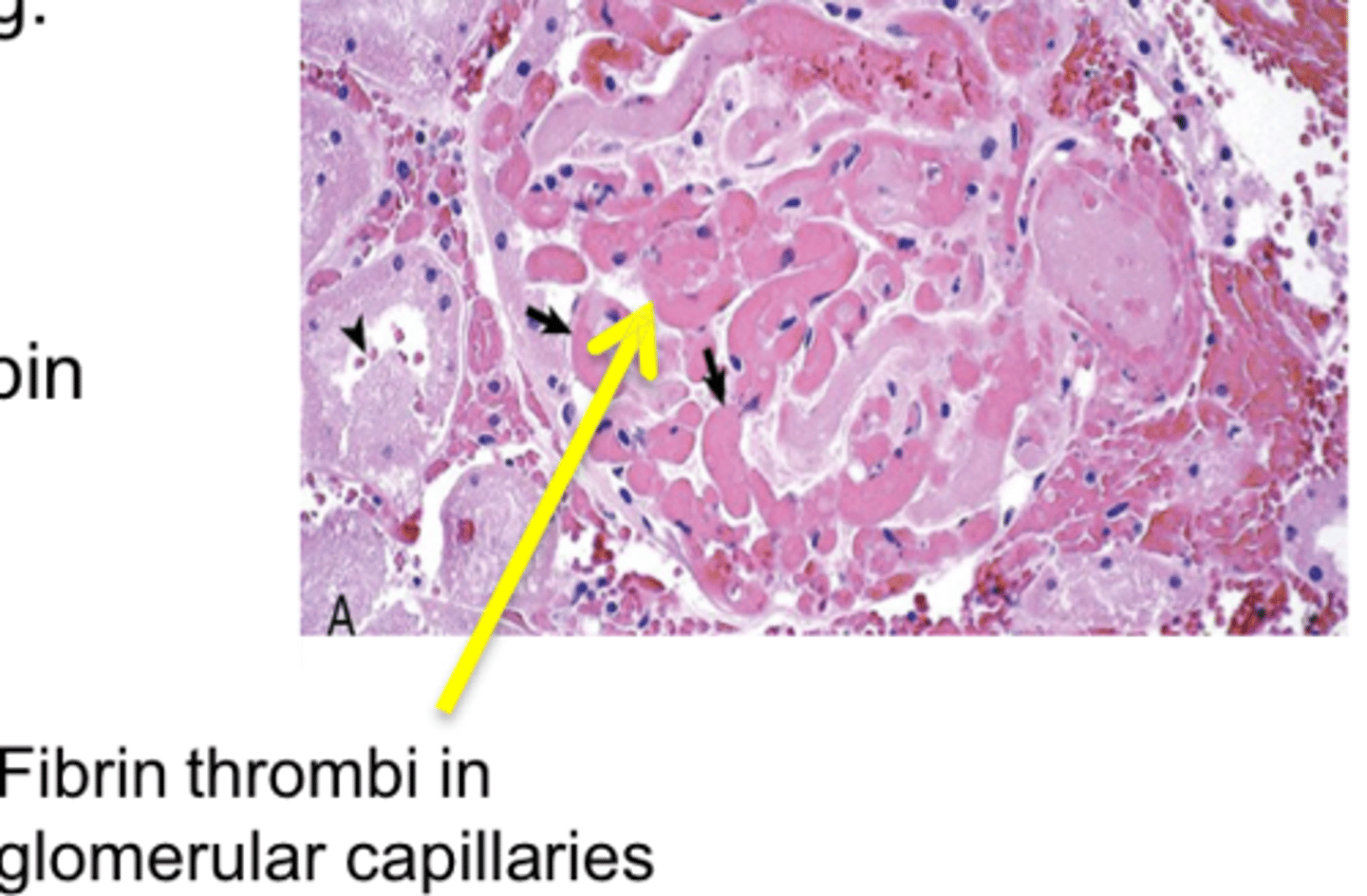 <p>Pathological blood clotting in blood vessels or lymphatics</p>
