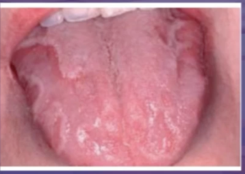 <p>what is the dx of this lesion that keeps changing locations </p><p>geographic tongue </p><p>erythematous candidiasis </p><p>pyostomatitis vegetans </p><p>lichen planus </p>