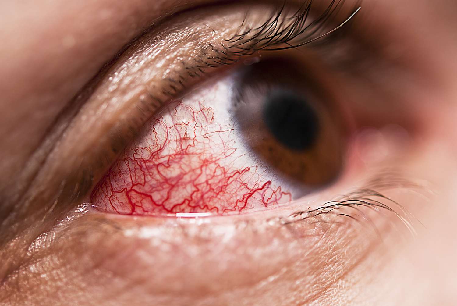 <ul><li><p>80% of cases&nbsp;</p></li><li><p><span style="color: green"><u>Sectoral or diffuse redness</u></span> -<span style="color: purple"><strong> dilated episcleral vessels WITH areas of </strong></span><span style="color: red"><strong>WHITE </strong></span><span style="color: purple"><strong>unlike Scleritis&nbsp;</strong></span></p></li><li><p>Px reports<span style="color: blue"> mild ache or burning sensation of </span><span style="color: purple"><strong>acute </strong></span><span style="color: blue"><strong>onset</strong></span></p></li><li><p>Eye will be <span style="color: blue">tender to touch + watery, painful</span></p></li><li><p><span style="color: red">No affect on VA, rarely photophobia</span></p></li></ul><p></p>