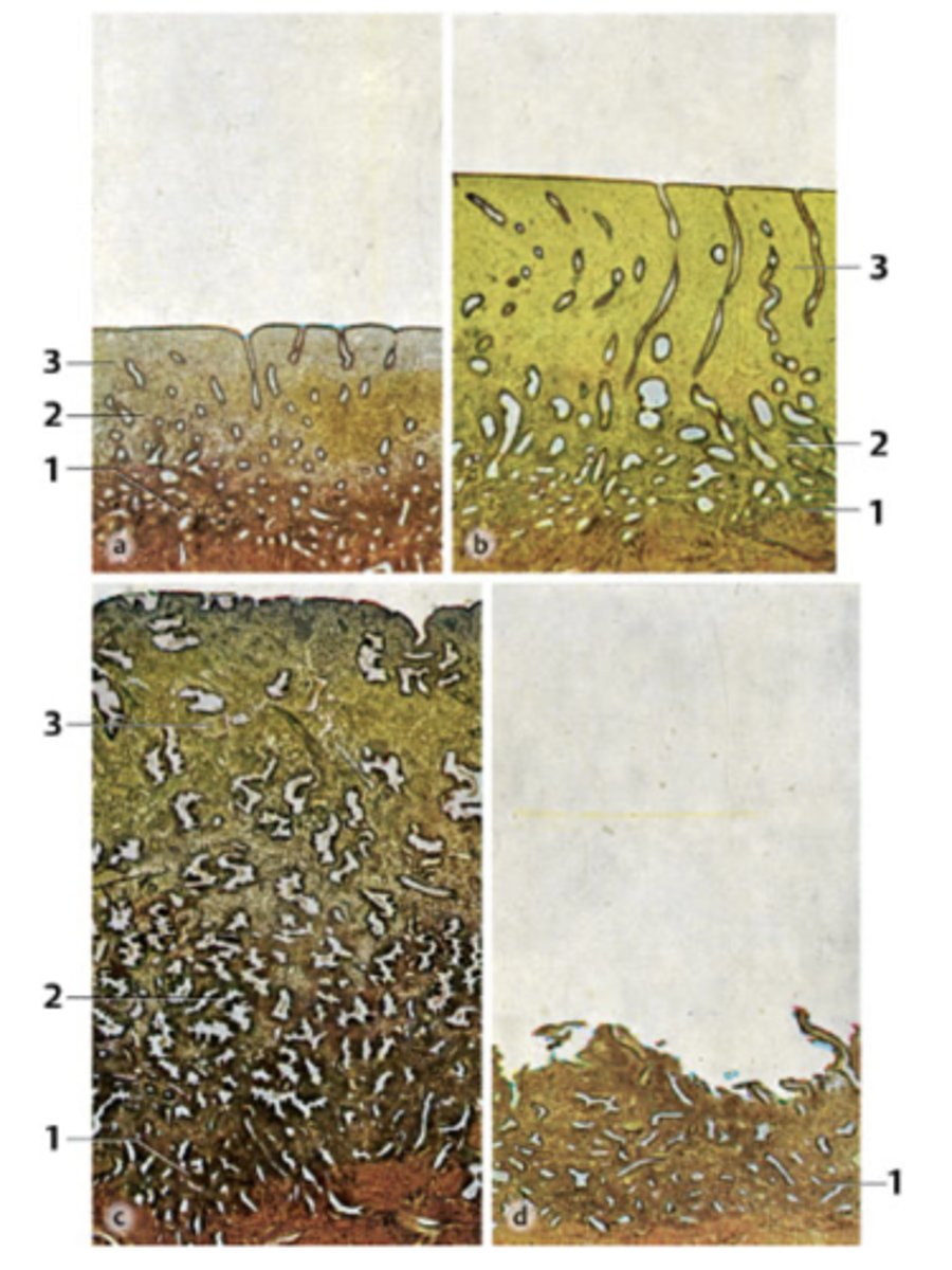 <p>A 39-year-old woman presents with infertility. She has regular menstrual periods with a 28-day cycle, and she bleeds heavily for the first 3 days. Her physician explains that she will need a thorough examination of hormonal levels and endometrial features spanning through the entire menstrual cycle. Endometrial biopsies (all micrographs with same magnification) obtained from her through the cycle are seen in the figure.</p><p>Which phase is at 1?</p>
