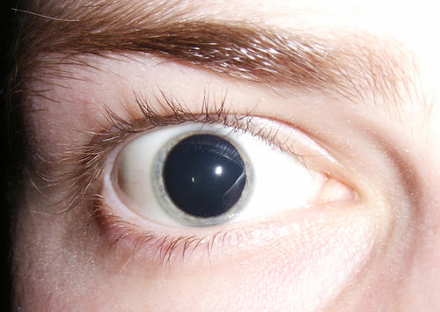 <p>Mydriasis</p><p>- Pupil dilation by contraction of radial/ dilator muscles</p>