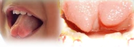 <p><strong><u>Bifid Tongue</u></strong></p><p class="has-focus">Rare congenital anomaly, lack of fusion of the two lateral parts of the tongue</p><p class="has-focus">Most common partial cleft</p><p class="has-focus"></p><p class="has-focus is-empty"><strong>Treatment </strong>- None required, possible accumulation of food debris and bacteria at base of cleft - clean well to avoid irritation.</p><p class="has-focus is-empty"></p><p class="has-focus is-empty"><em>DD - Partial ankyloglossia</em></p>