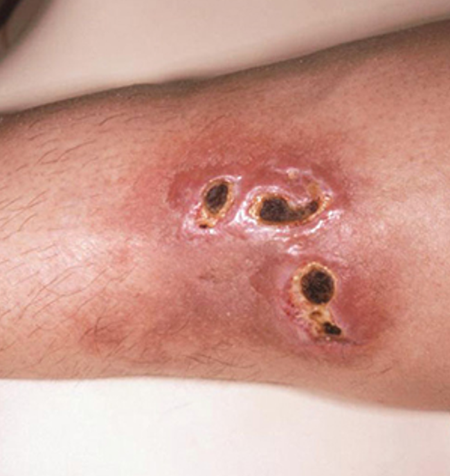 <ul><li><p>assoc. w/ constitutional sx- fever, fatigue, malaise, arthralgias, loss of appetite </p></li><li><p>skin lesions- purpura, livedo reticularis, painful nodules, ulcers follow ischemia of nodules</p></li><li><p>location: lower legs, thighs, arms, trunk, head, neck, buttocks</p></li><li><p>risk: male and age</p></li></ul><p></p>
