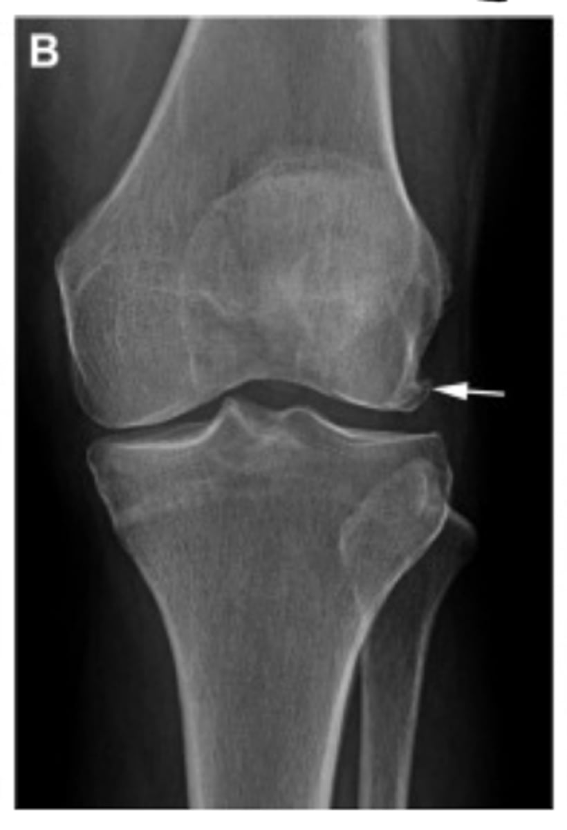<p>Define the Kelgren Lawrence grade. How do you know?</p>
