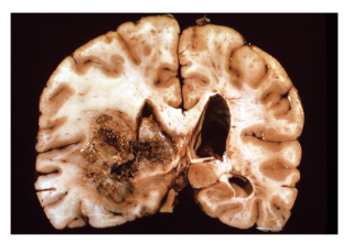 <p>What type of brain lesion is this?</p>