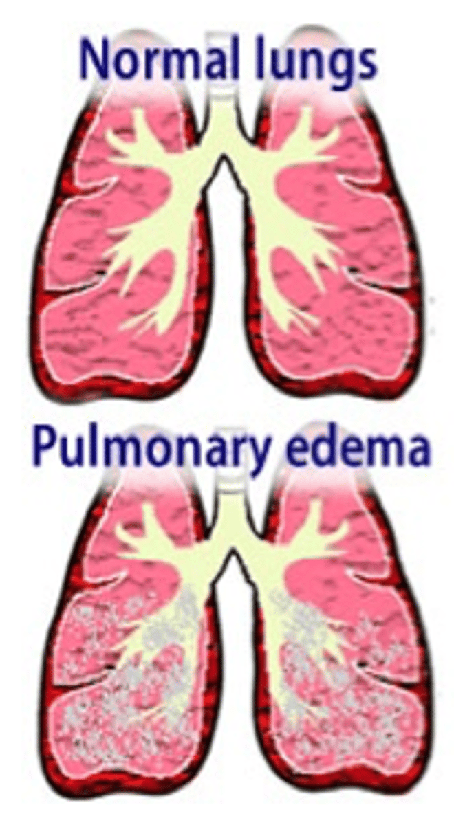 <p>pulmonary edema</p>