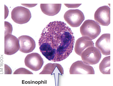 <p><strong>less common</strong>, <strong>1–4% </strong>of leukocytes</p><ul><li><p><strong>Bilobed nucleus</strong> connected by thin strand</p></li><li><p>Cytoplasm has<strong> reddish granules</strong></p></li><li><p><strong>Phagocytize </strong>antigen-antibody complexes or <strong>allergens</strong></p></li><li><p><strong>Active </strong>in cases of <strong>parasitic worm infection</strong></p></li></ul><p></p>