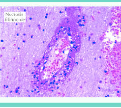 <p>Depósito de inmunocomplejos.</p>