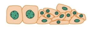 <p>Dysplasia</p>