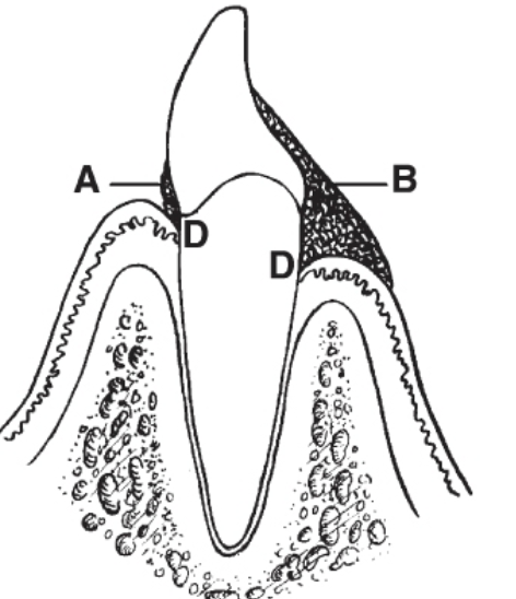<p>Calculus Detection: <strong>Supra</strong>gingival</p>