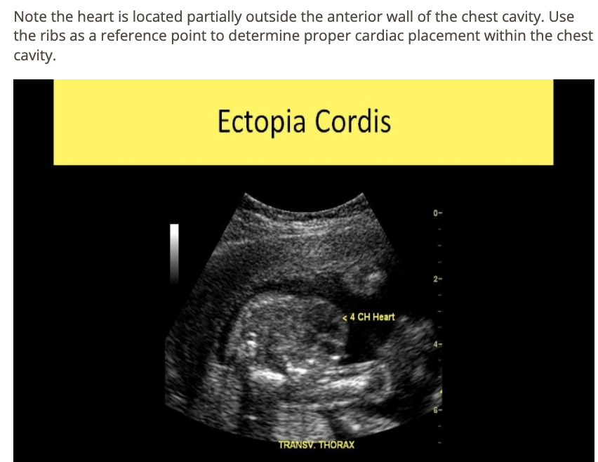 <p>b) ectopia cordis</p>