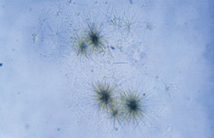 Tyrosine crystals in fine needle clumps