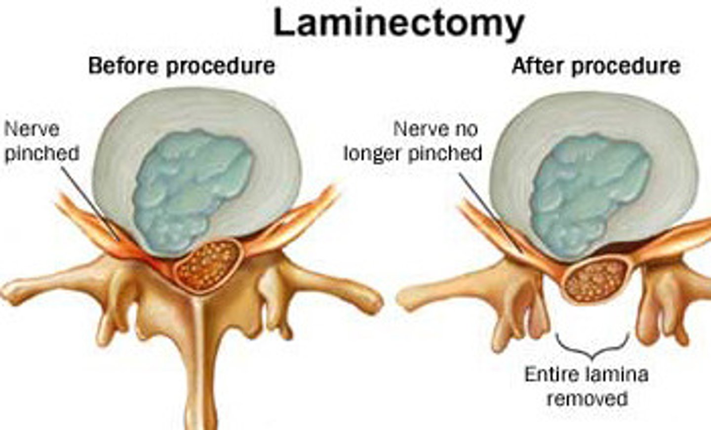 <p>laminectomy</p>