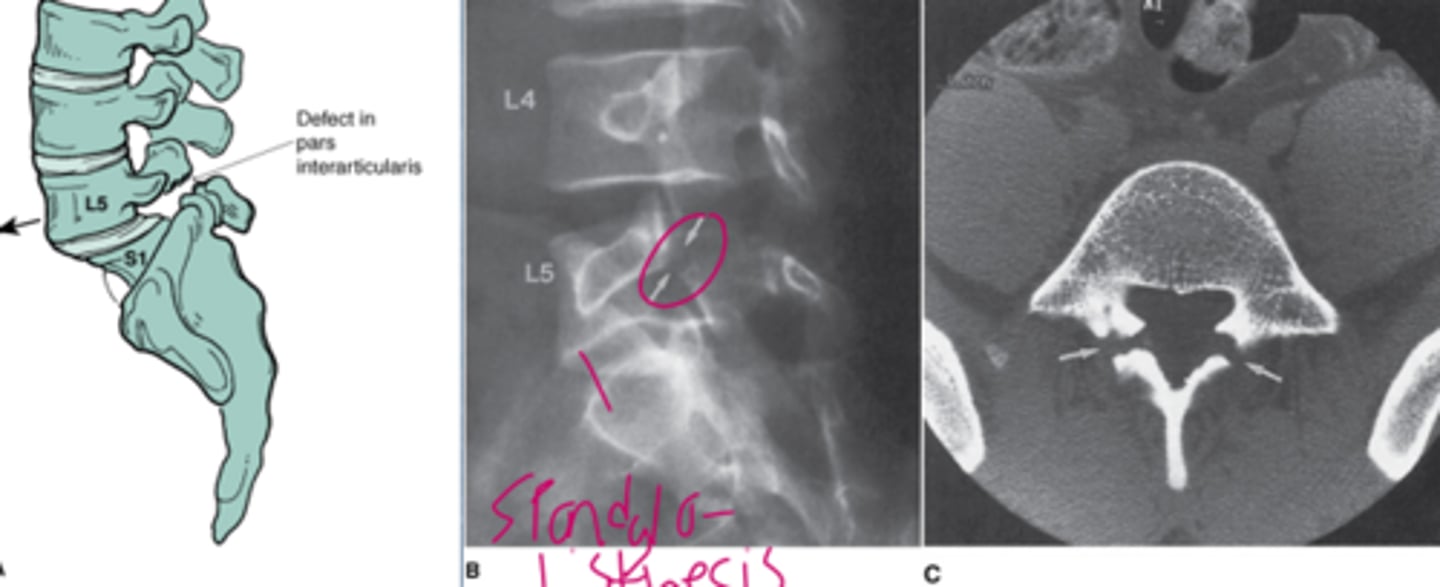 <p>-Spondylolisthesis</p><p>-L5 over S1</p>