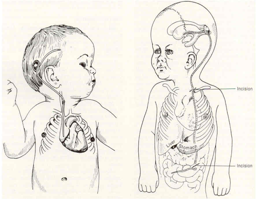 <p>What condition is being treated in the image below?</p>