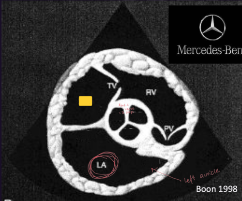 <p>Right Parasternal Short Axis View&nbsp;</p>
