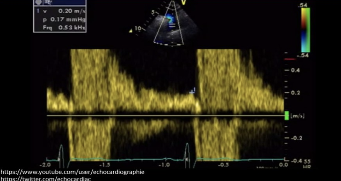 <p>Definitive sign of severe aortic regurgitation </p>