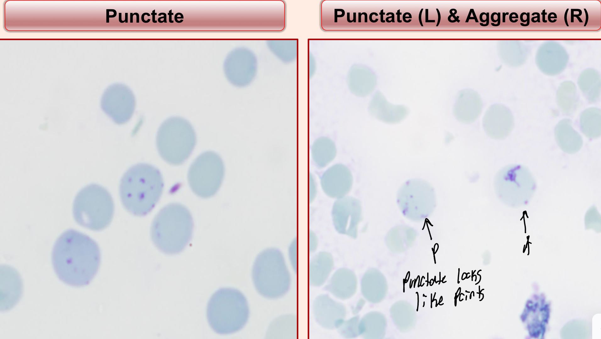 <ol><li><p>Aggregate</p><ol><li><p>We count these ones</p></li><li><p>Larger cells with aggregates of reticulum</p></li></ol></li><li><p>Punctate</p><ol><li><p>Smaller granules, 2-6 reticulum</p></li><li><p>They look like individual flakes of pepper or individual circles </p></li></ol></li></ol><p></p>