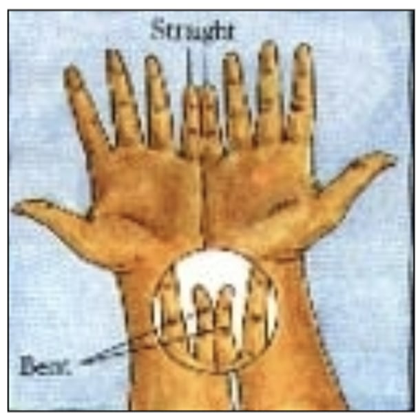 <p><strong>Bent pinky</strong></p><p><span class="bgP">- dominant trait</span></p><p></p><p><strong>Straight pinky</strong></p><p><span class="bgP">- recessive trait</span></p><p></p><p>*hold your hands together as if you are covering your face. if the tips of the pinkies point away from one another, the pinkies are bent</p>