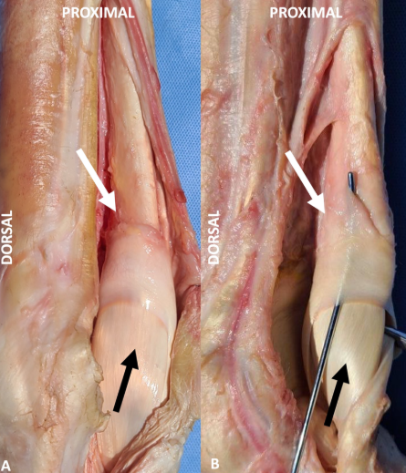 <p>→ Partie du OBS qui entoure dorsalement le TBS dans la partie prox. du canal suspenseur du boulet</p><ul><li><p>Proximal aux Os. sesamoidea prox. et Lig. suspenseur du boulet </p></li></ul><p></p>