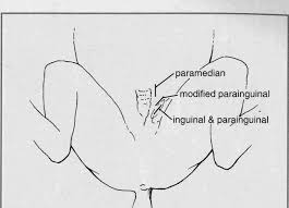 <p>An incision is made several cm medial to the inguinal ring<span>; cranially to the external inguinal canal</span>. Incision between raphe scroti and left leg. Cut rectus abdominis,<span>&nbsp;aponeurosis of external abdominal oblique muscle</span>.</p>