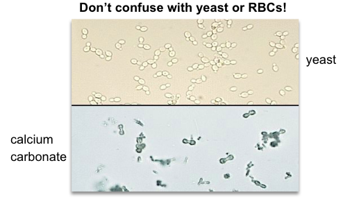 <p>Normal</p><ul><li><p>alkaline urine</p></li><li><p>soluble: HCl and acetic acid will make it bubble (effervesce)</p></li><li><p>Can be confused with yeast, RBC</p></li></ul><p></p>