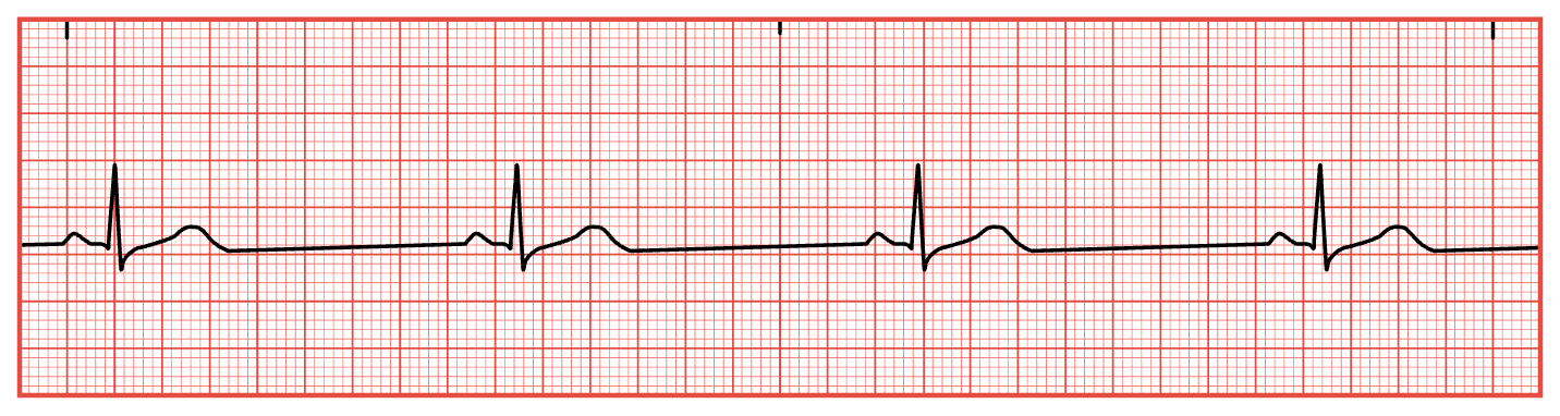 <ol type="1"><li><p><span style="font-family: &quot;Times New Roman&quot;;">Calculate heart rate.</span></p></li><li><p><span style="font-family: &quot;Times New Roman&quot;;">Determine if heart rhythm is regular.</span></p></li><li><p><span style="font-family: &quot;Times New Roman&quot;;">Assess for P waves.</span></p></li><li><p><span style="font-family: &quot;Times New Roman&quot;;">Measure PR interval.</span></p></li><li><p><span style="font-family: &quot;Times New Roman&quot;;">Measure duration of QRS complex.</span></p></li></ol><ul><li><p><span style="font-family: &quot;Times New Roman&quot;;"><strong>Faculty Note:</strong></span></p><ul><li><p><span style="font-family: &quot;Times New Roman&quot;;">Sinus bradycardia occurs when the SA node sends an electrical impulse slower than 60 bpm.</span></p></li><li><p><span style="font-family: &quot;Times New Roman&quot;;">The ECG criteria for sinus bradycardia remains the same as what is expected to be identified during NSR.</span></p></li><li><p><span style="font-family: &quot;Times New Roman&quot;;">Causes for SB: genetics, MI, sleep apnea, increased intracranial pressure, decrease in metabolic needs (eating disorder), increased exercise tolerance, hypothyroidism, vagus nerve stimulation (frequent coughing, excessive gagging, and straining for a bowel movement) all may lead to bradycardia.</span></p></li><li><p><span style="font-family: &quot;Times New Roman&quot;;">Bradycardia is also associated with Lyme disease, typhoid fever, malaria, Rocky Mountain Spotted Fever, medications, normal aging and prolonged hypoxia.</span></p><p></p></li></ul></li></ul><p></p>