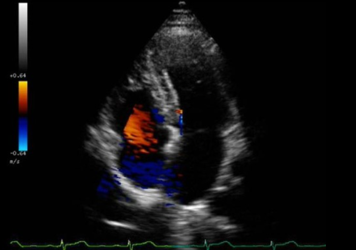 <p>What color Doppler artifact is demonstrated on the image?</p><p>a. cross talk <br>b. flash<br>c. mirror image<br>d. defocusing</p>